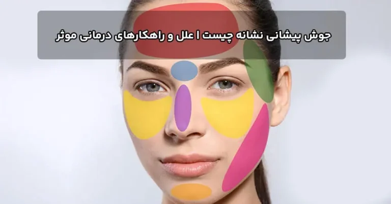 جوش پیشانی نشانه چیست | علل و راهکارهای درمانی موثر