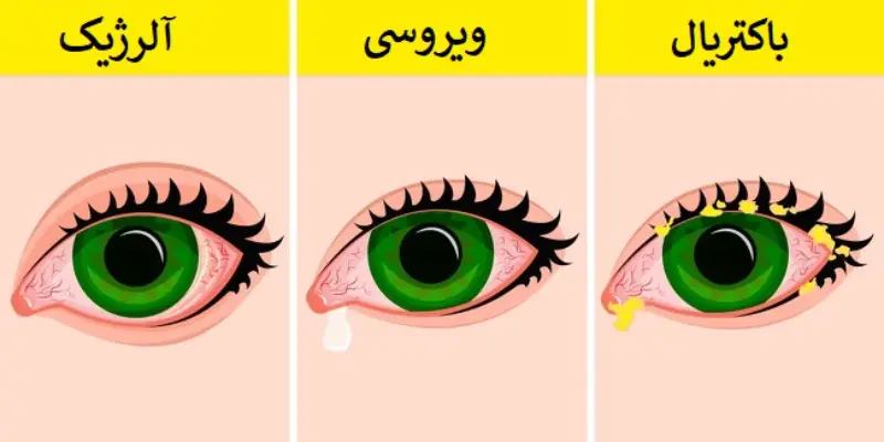 کمک به درمان عفونت چشم با چای